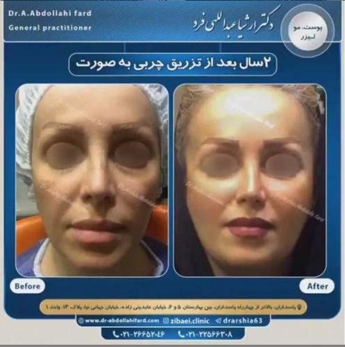 تزریق چربی در تهران 34