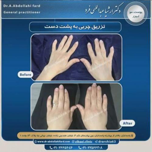 تزریق چربی در تهران 35
