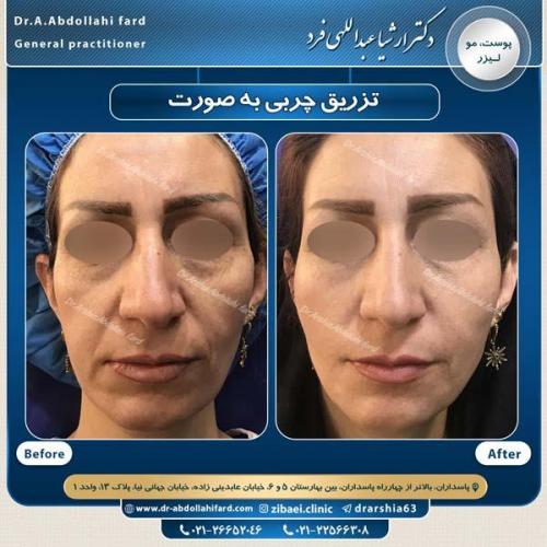 تزریق چربی در تهران 36
