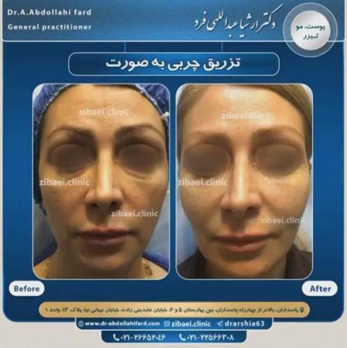 تزریق چربی در تهران 37
