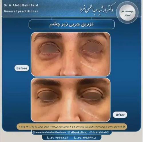 تزریق چربی در تهران 38