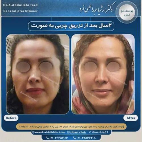 تزریق چربی در تهران 39