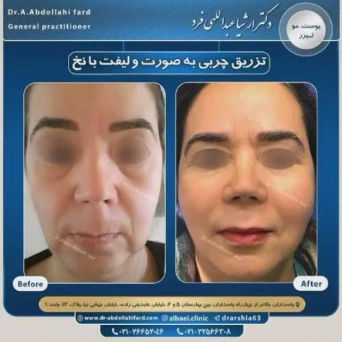 تزریق چربی در تهران 41