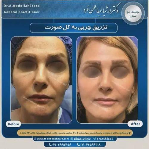 تزریق چربی در تهران 42