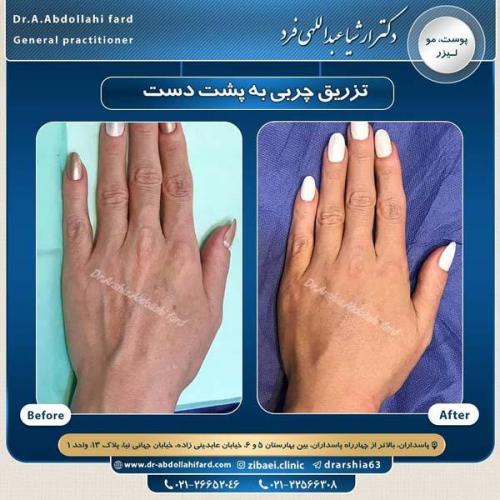 تزریق چربی در تهران 43