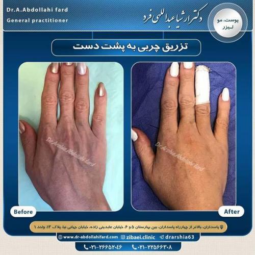 تزریق چربی در تهران 44