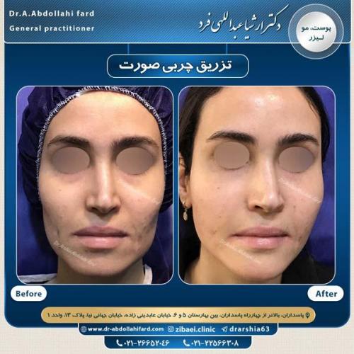 تزریق چربی در تهران 45