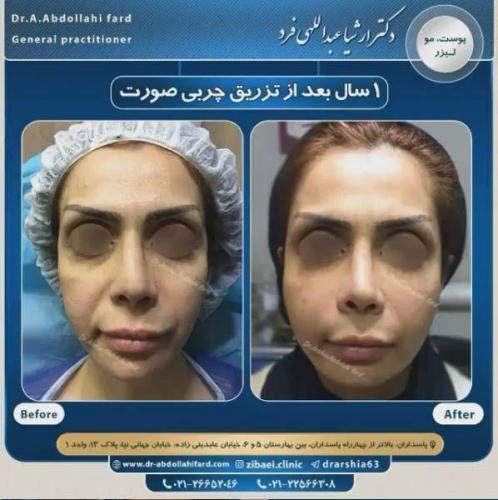 تزریق چربی در تهران 46