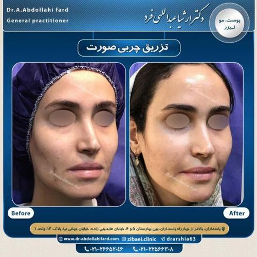 تزریق چربی در تهران 47
