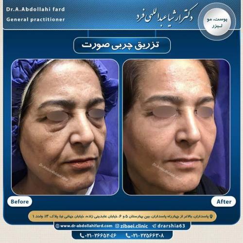 تزریق چربی در تهران 48