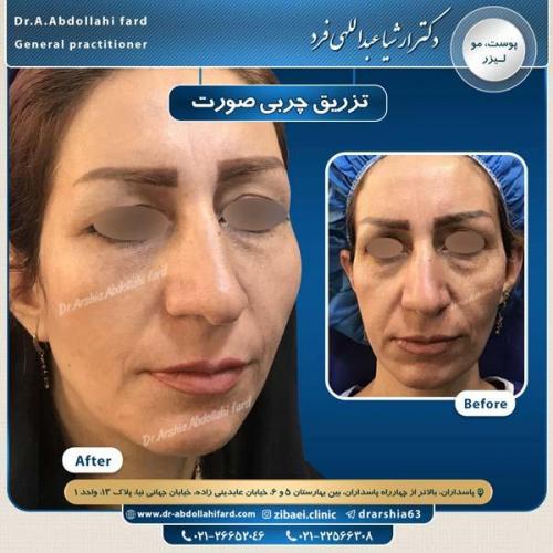 تزریق چربی در تهران 49