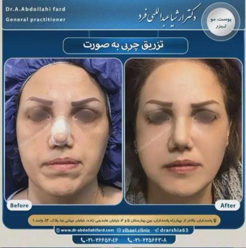 تزریق چربی در تهران 50