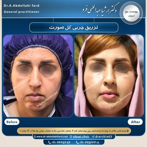 تزریق چربی در تهران 54