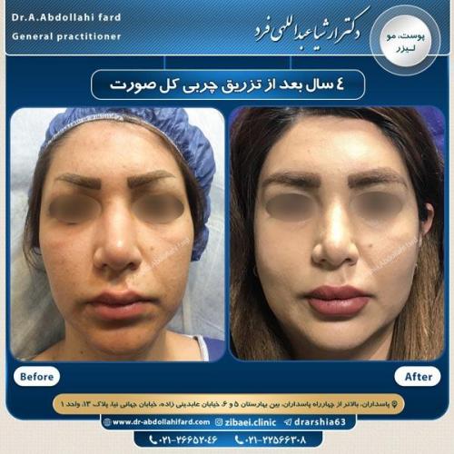 تزریق چربی در تهران 55