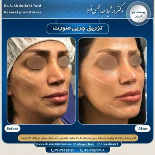 تزریق چربی در تهران 56