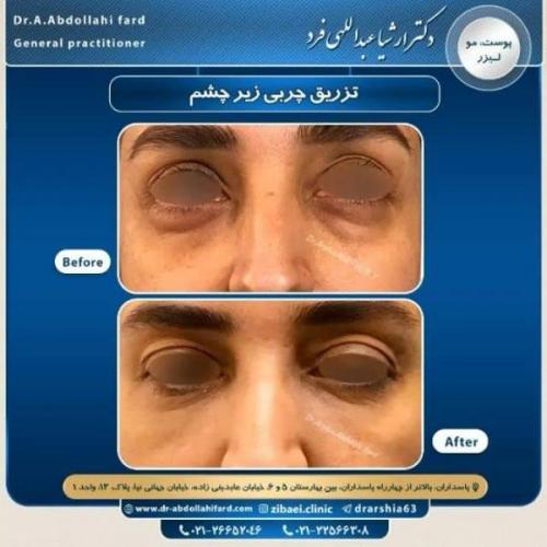 تزریق چربی در تهران 57
