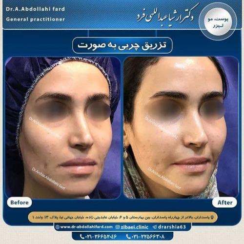 تزریق چربی در تهران 58