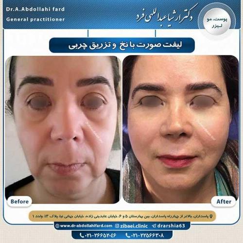 لیفت-با-نخ-و-تزریق-چربی-1