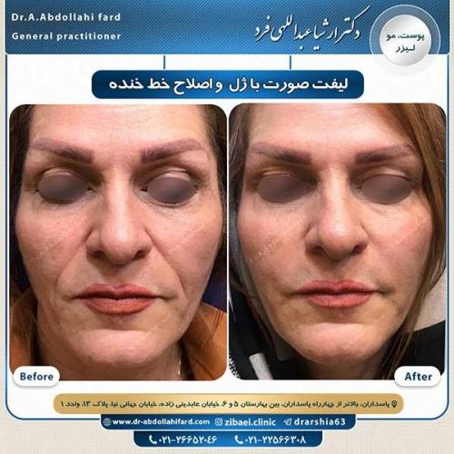 1--تزریق-ژل-و-اصلاح-خط-خنده