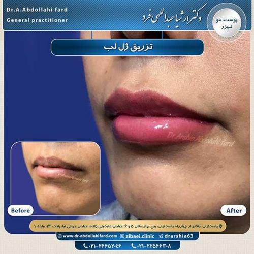 تزریق-ژل-1