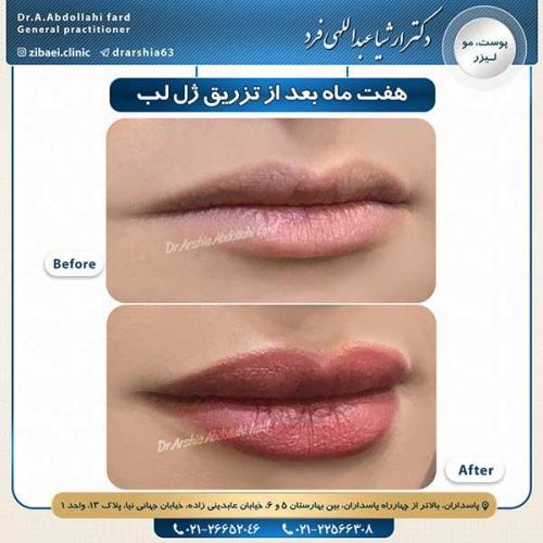 تزریق-ژل-2