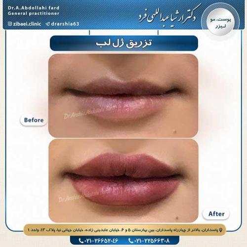تزریق-ژل-3
