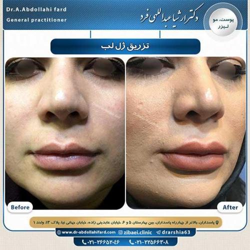 تزریق-ژل-لب-1