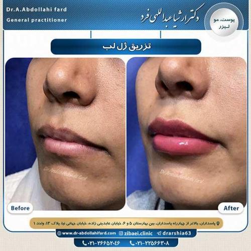 تزریق-ژل-لب-2