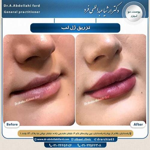 تزریق-ژل-لب-3