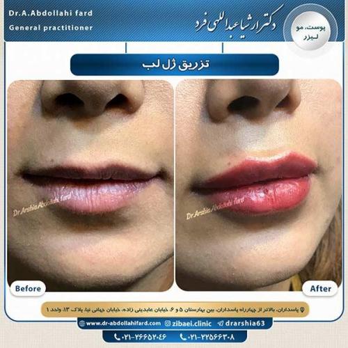 تزریق-ژل-لب-4