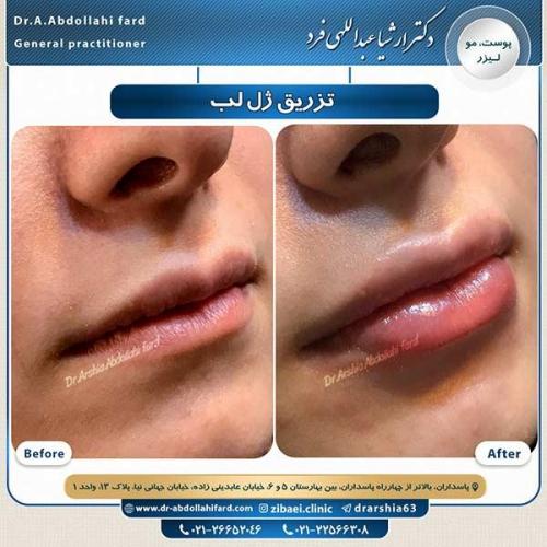 تزریق-ژل-لب-5