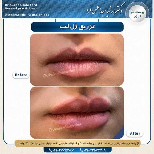 تزریق-ژل-لب-6