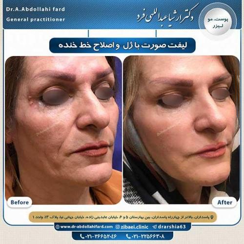تزریق-ژل-و-اصلاح-خط-خنده