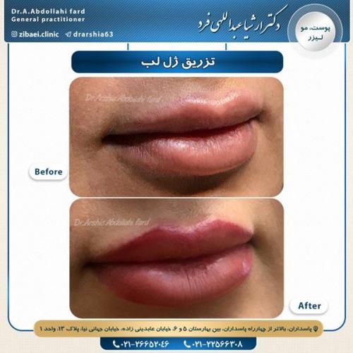 تزریق ژل 1
