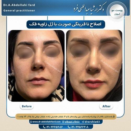 تزریق ژل 2