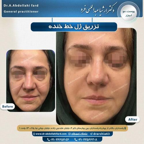 تزریق ژل 2 (1)