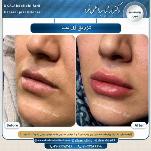 تزریق ژل 3