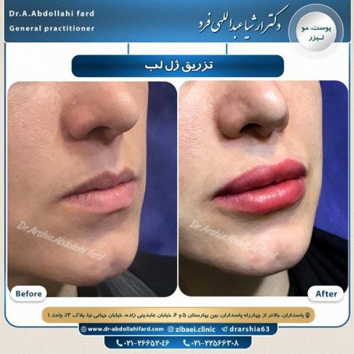 تزریق ژل 4