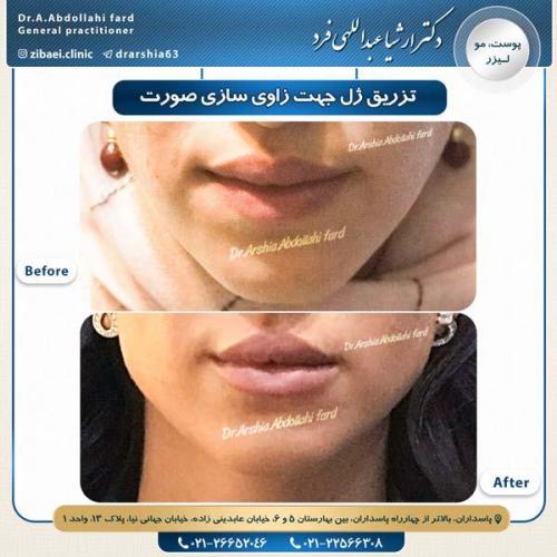 تزریق ژل 5