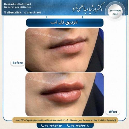 تزریق ژل 7