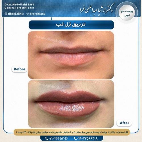 تزریق ژل 8