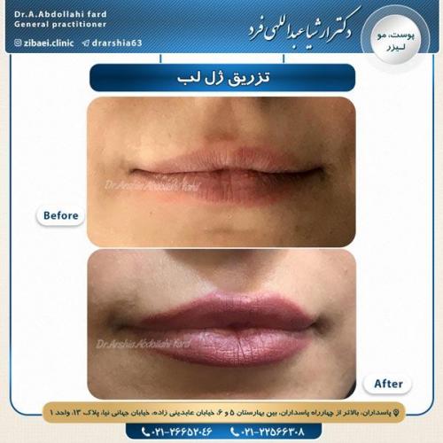 تزریق ژل 9