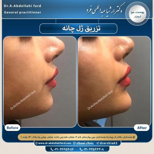 تزریق ژل در تهران 62