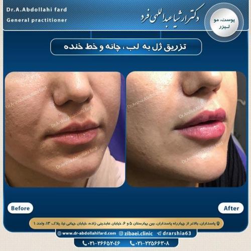 تزریق ژل در تهران 63