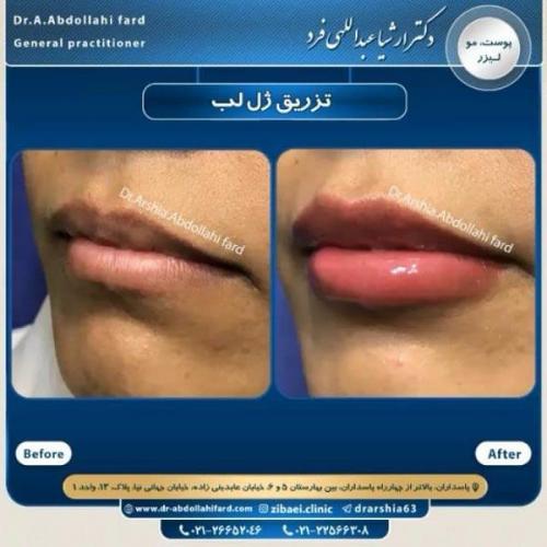 تزریق ژل در تهران 66