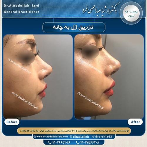 تزریق ژل در تهران 67