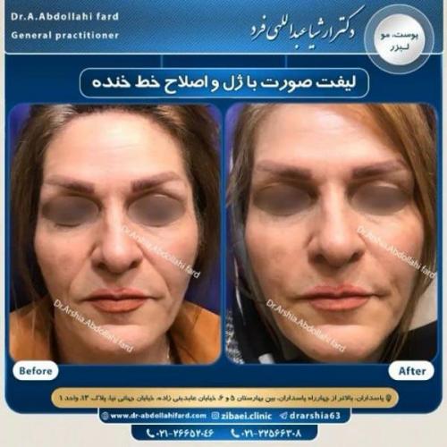 تزریق ژل در تهران 68