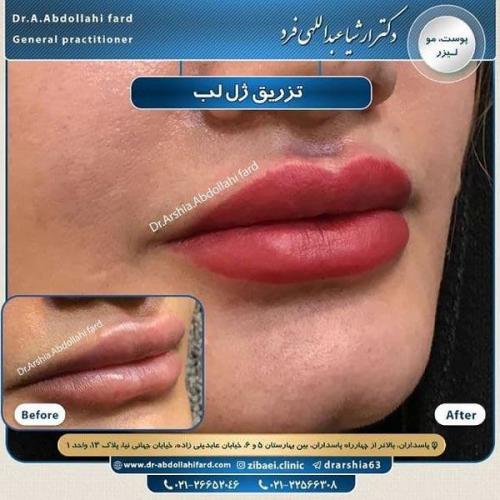 تزریق ژل در تهران 69