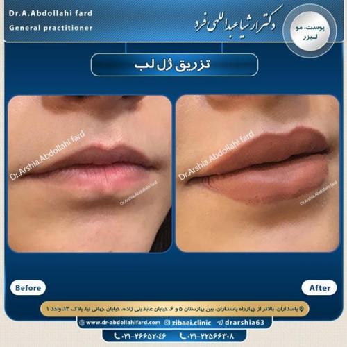 تزریق ژل در تهران 70