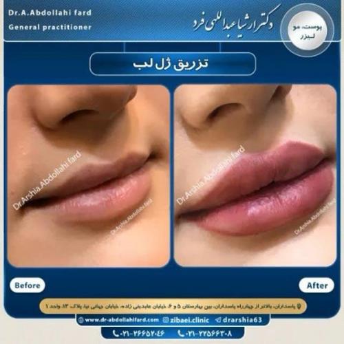 تزریق ژل در تهران 71